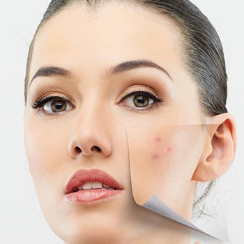 Do fillers work for acne scars