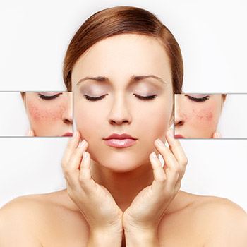 Benefits of laser acne scar removal
