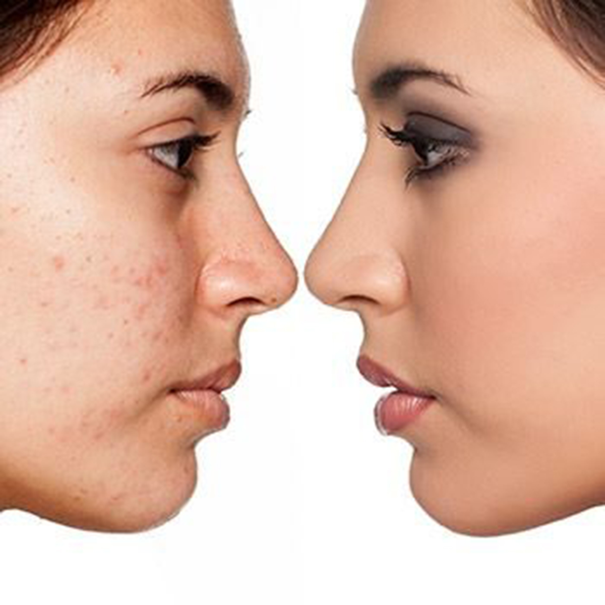 Treatment for pimple scars