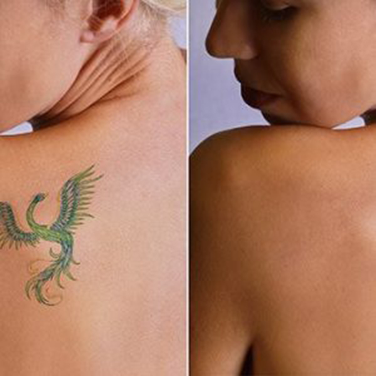 Dermatologist describes how to remove tattoos
