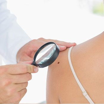 Specialists resolve concerning skin cancer symptoms