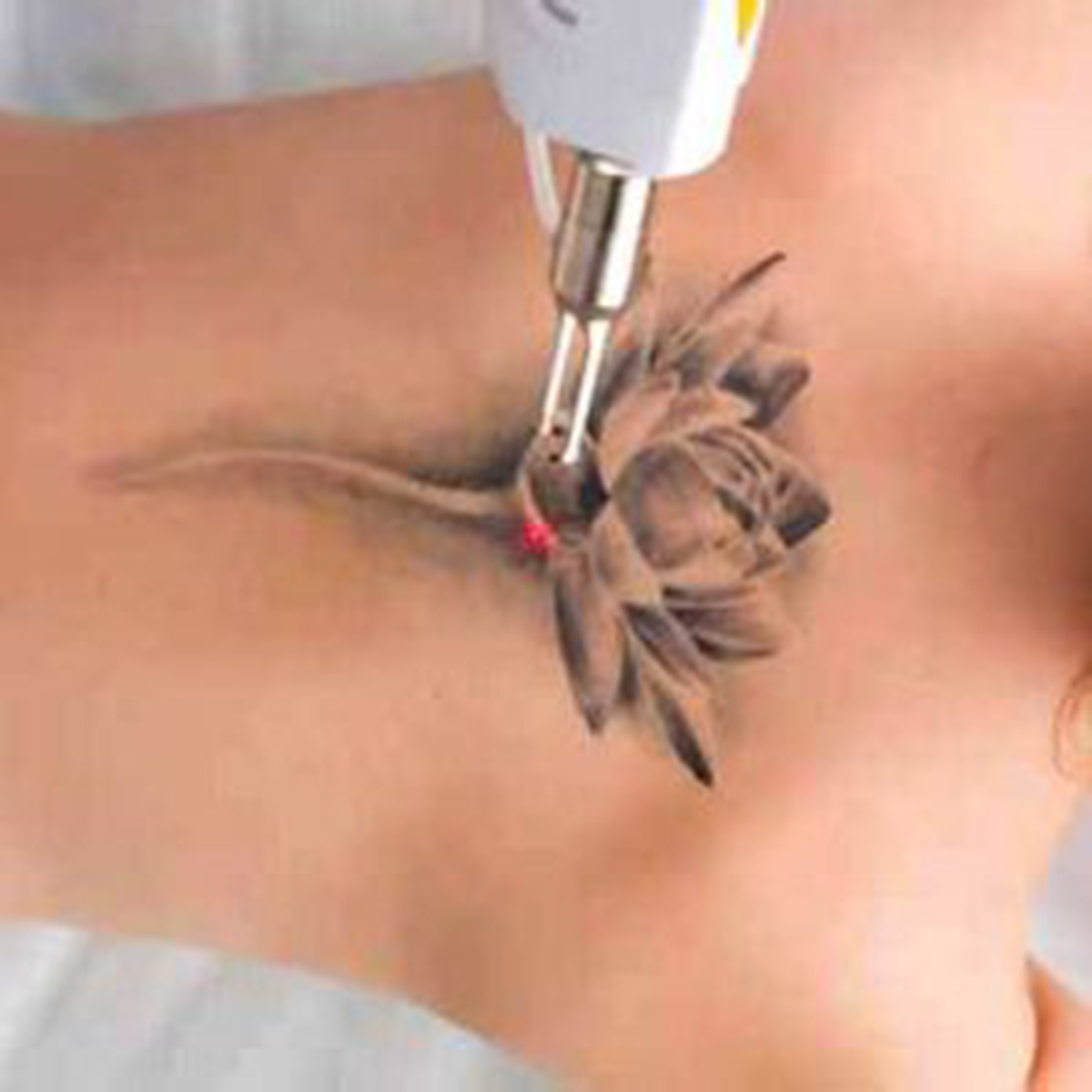 Dr. M. Christine Lee and her team of professionals at The Skin and Laser Treatment Institute welcome patients in the community who are interested in tattoo removal versus traditional coverup tattoos often recommended.