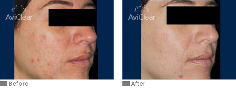 Before and After 3 Treatment AviClear Treatment Walnut Creek CA