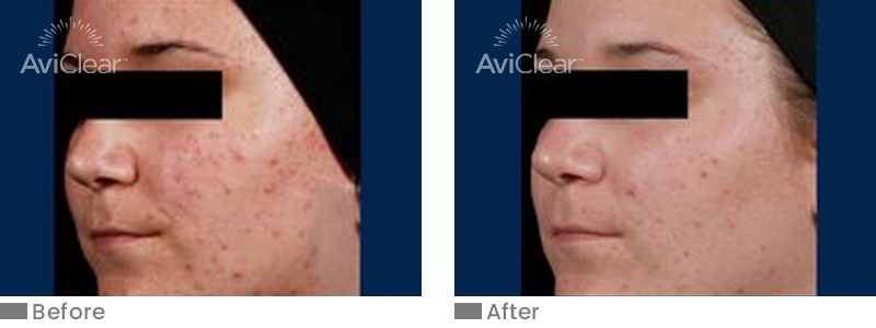 Before and After 2 Treatment AviClear Treatment Walnut Creek CA